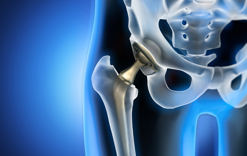 Muscle sparing hip surgery | HealthFocus SA | University Health