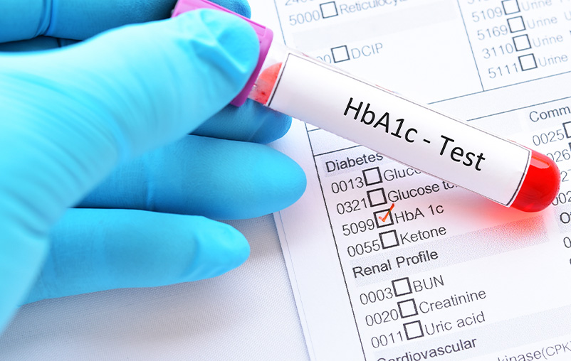 Blood sample tube with laboratory requisition form for HbA1c test, diabetes diagnosis
