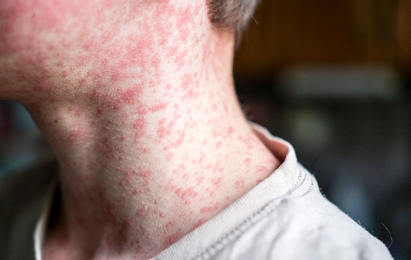 Measles symptoms on a male's neck.